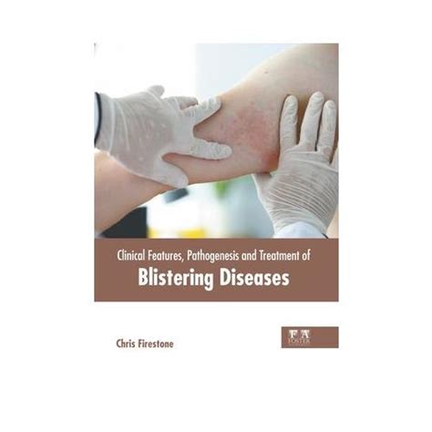 Clinical Features Pathogenesis And Treatment Of Blistering Diseases