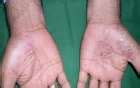 Psoriasi: immagini e foto per riconoscerla (Foto) | Salute ...