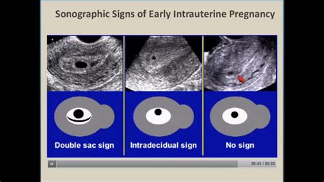 First Trimester Ultrasound Non Viable Fetus Youtube