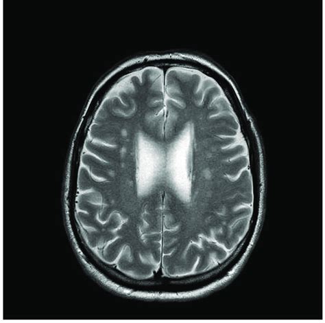 Brain Magnetic Resonance Imaging Mri Scan Conducted On Presentation