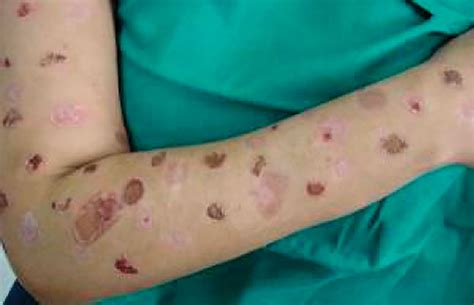 Self Induced Skin Conditions Differential Diagnosis And Management