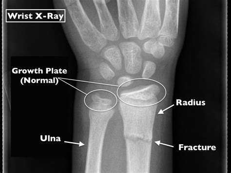 What Makes A Pediatric Wrist Fracture Different