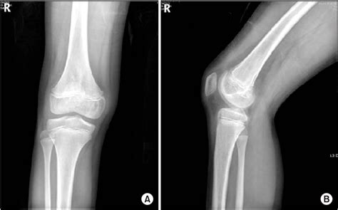 Figure 7 From Juvenile Hemangioma Occurred In Distal Femoral Epiphysis Semantic Scholar