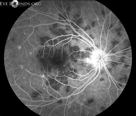 Apmppe is an inflammatory disease of the retina and choroid, tissues that line the back of the eye, much like the film in a camera. Acute posterior multifocal placoid pigment epitheliopathy ...