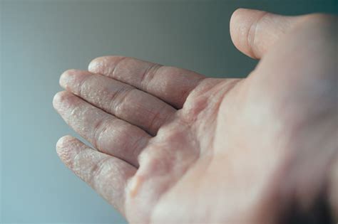 A Man Hand Palm With Dyshidrotic Or Pompholyx Eczema Illness Stock
