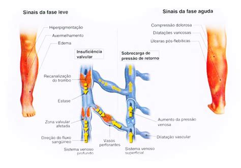 Bij trombose raakt een bloedvat verstopt door een bloedstolsel. Saúde do Adulto: Trombose Venosa Profunda (TVP)