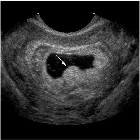 Pearls And Pitfalls In First Trimester Obstetric Sonography Clinical