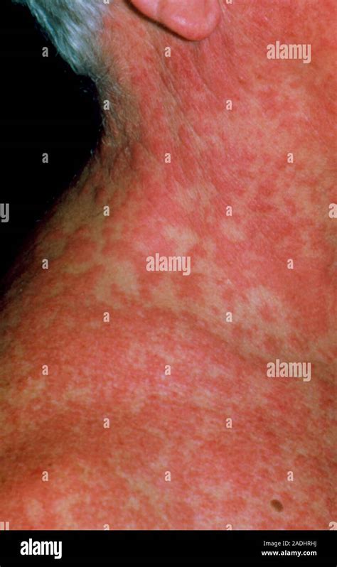 Extensive Rash Over A Mans Neck And Upper Chest Erythema Due To An