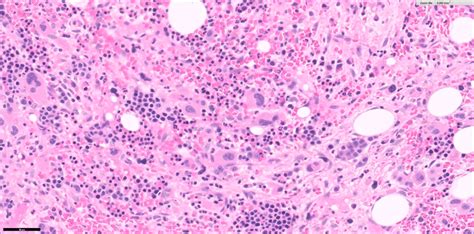 Pathology Outlines Acute Panmyelosis With Myelofibrosis