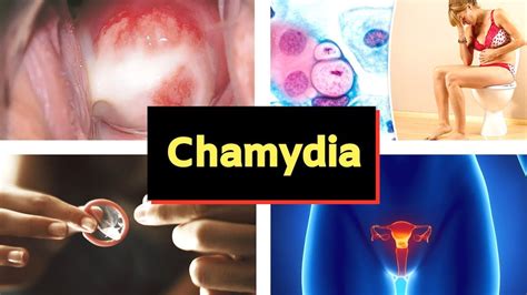 Chlamydia In The Mouth