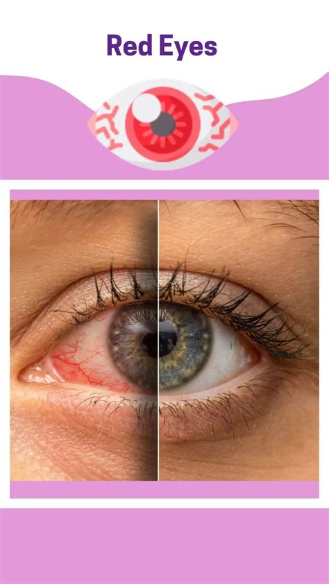 10 Serious Causes Of Red Eyes And How To Treat Them Credihealth
