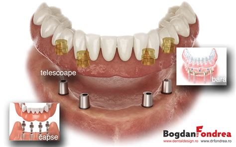 Supraprotezarea Cu Sprijin Pe Implanturi Dentare Dr Bogdan Fondrea