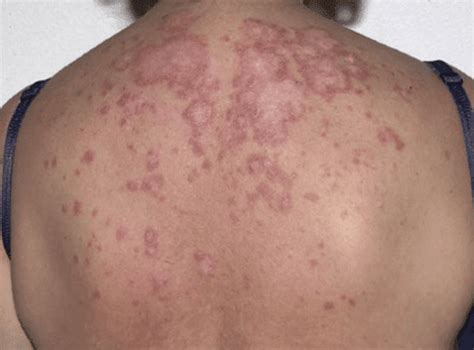What Causes An Autoimmune Rash 10 Possible Conditions Pictures