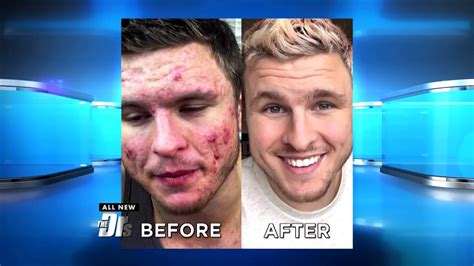 How One Man Defeated His Cystic Acne Through Changing What He Ate Youtube