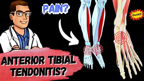 Tibialis Anterior Tendonitis Tendonitis On Top Of Foot Treatment Youtube
