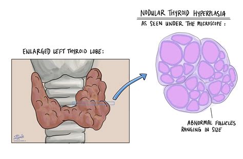 Types Of Thyroid Nodules