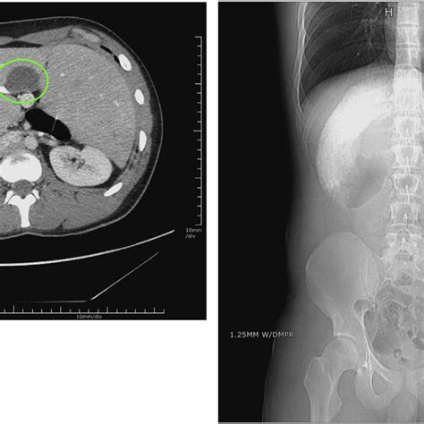 41 Abdominal Ct Axial View Showing A Mid Pelvic Appendix That Is