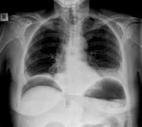 Abdominal Xray Flashcards Quizlet