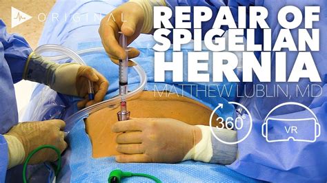 Indications For Hernia Repair Paraumbilical Hernia Repair By