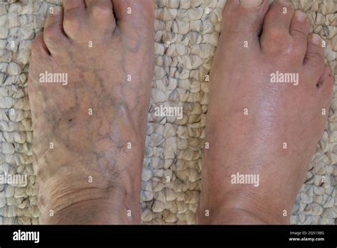 Veins Feet Hi Res Stock Photography And Images Alamy