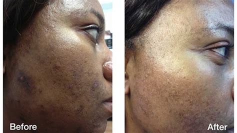 Skin Discoloration Treatment For Dark Skin In Seattle Wa