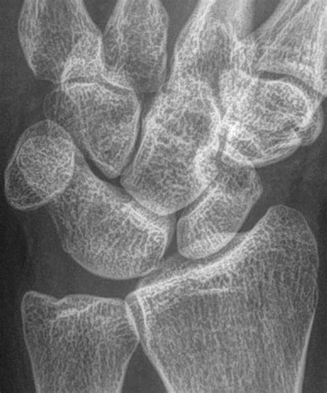 Carpal Coalitions On Radiographs Prevalence And Association With Ordering Indication Journal