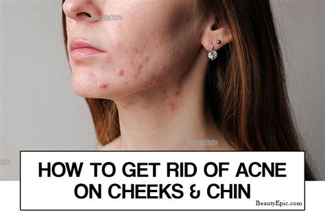 How To Get Rid Of Acne On Cheeks And Chin Naturally