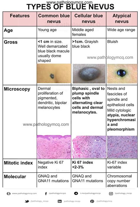 Types Of Blue Nevus Rdermatologyquestions