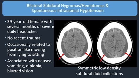 Chronic Subdural Hematoma Ct Sexiz Pix