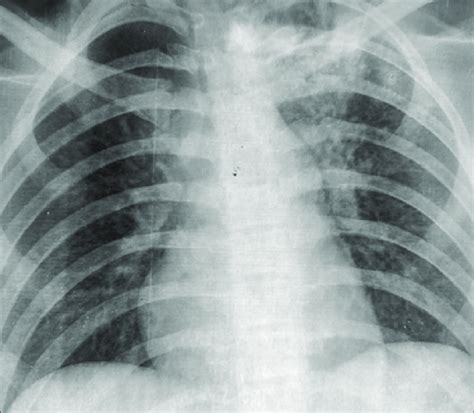 Chest X Ray Showing Patchy Infiltrates In The Left Upper Zone