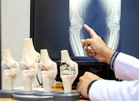 The Mako Knee Replacement What Do You Need To Know Orthovirginia