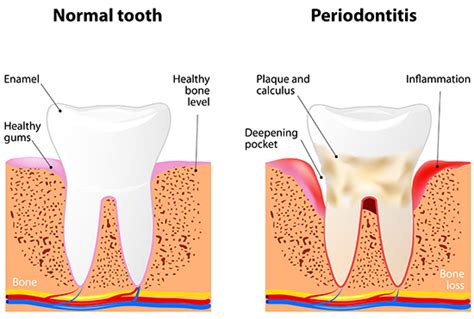 Gum Disease Treatments Russell D Borth Dds