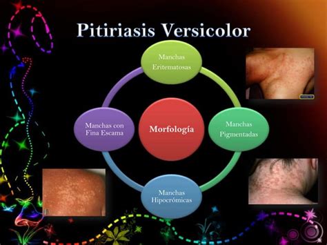 Pitiriasis Versicolor Candidosis Dermatología