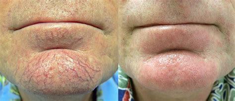 Facial Veins Broken Capillaries And Redness Modern Skin Clinic Of