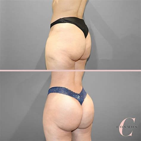 Am I A Good Candidate For A Brazilian Butt Lift Cosmos Clinic