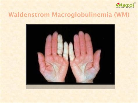 Waldenstrom Macroglobulinemia Wm By Lazoithelife Issuu