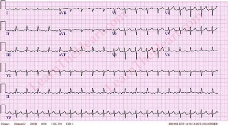 Atrial Tachycardia ECG Example Learn The Heart