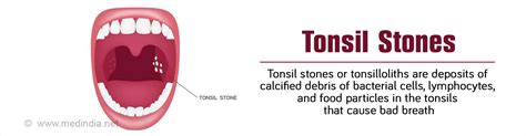 Tonsil Stones Causes Symptoms Diagnosis Treatment And Prevention