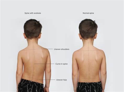What Are Some Signs Of Scoliosis Scoliosis Knowledge Hub