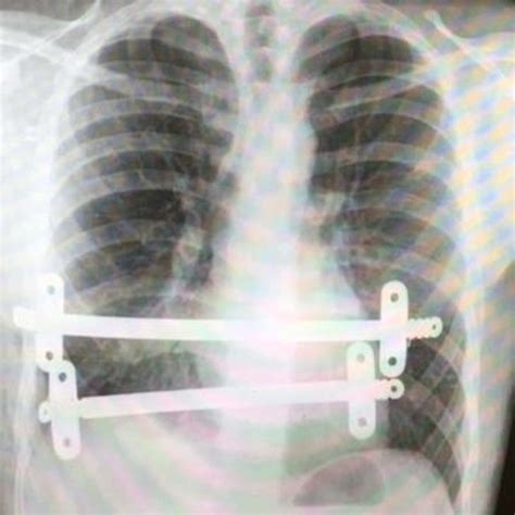 Postoperative Chest X Ray Following Initial Nuss Procedure Showing Download Scientific Diagram