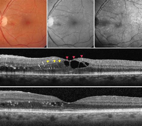 Macular Edema Following Cataract Surgery In A Diabetic Patient A