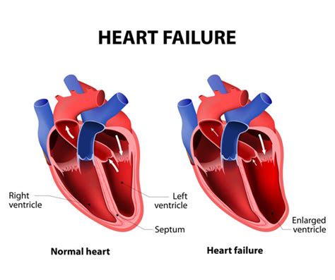 Congestive Heart Failure Carolina Primary Care