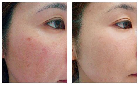 Laser Diffuse Redness Rosacea Essential Beauty Skin And Laser
