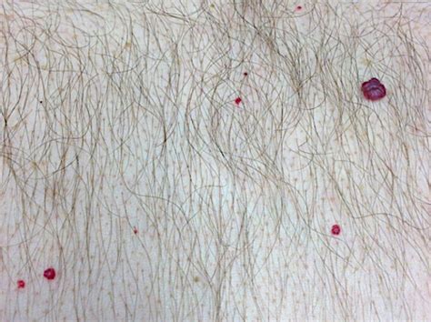 Cherry Angioma Small Blood Spot Removal With Diathermy