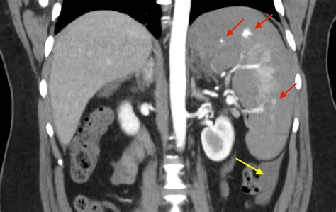Cureus Spontaneous Splenic Rupture In Atypical Pneumonia From