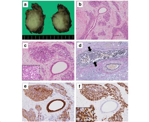 Macroscopic And Histological Findings Of The Salivary Gland Tumor A