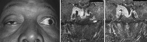 The Neuro Ophthalmology Of Pituitary Tumors Neupsy Key