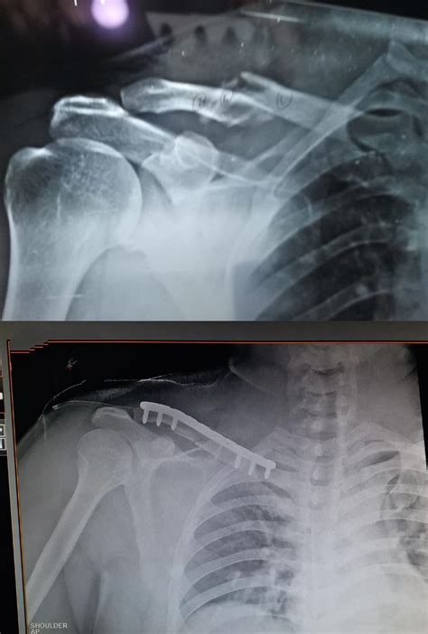 Old Healed Fracture Of Right Scapula And Clavicle