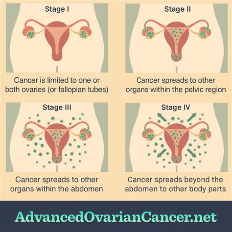 What Are The Stages Of Ovarian Cancer