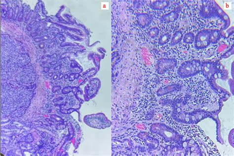 Cureus Squamous Cell Carcinoma Of Duodenum Secondary To Metastasis